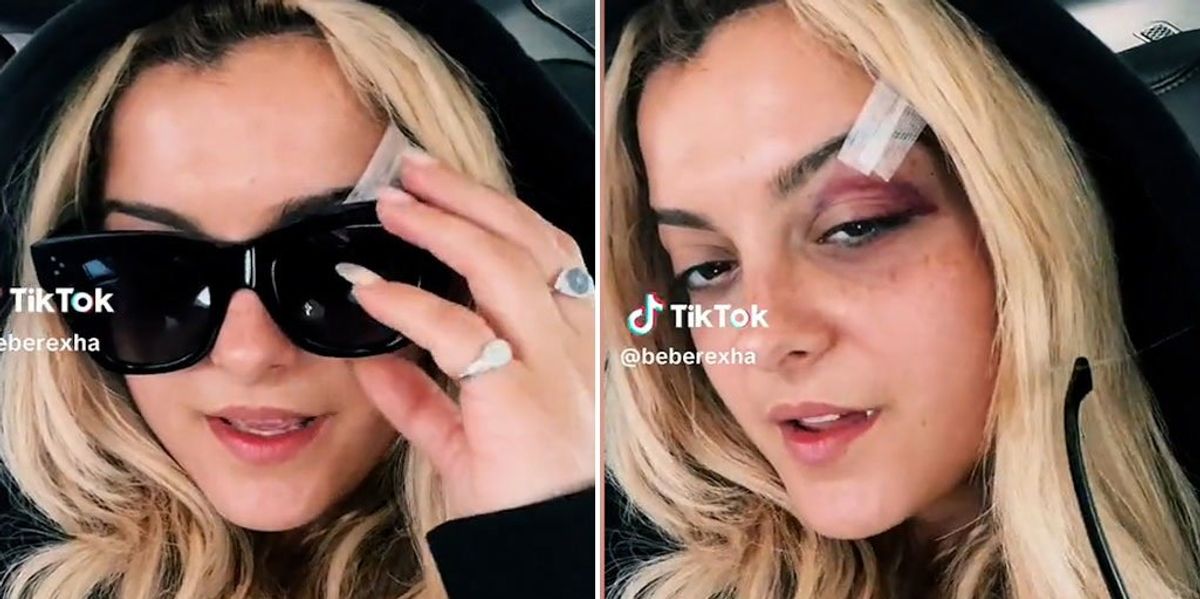 Bebe Rexha Shares Black Eye Update After Being Hit In Face By Phone During Concert Indy100