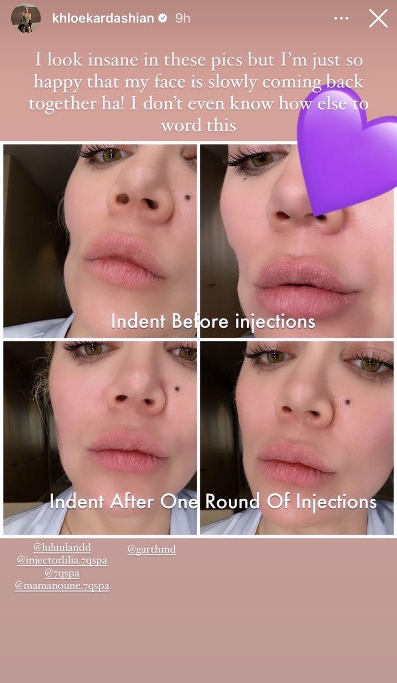 Khloe Kardashian reveals dent on her face after cancer treatment