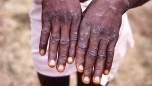 Monkeypox patient's nose is rotting after being dismissed as sunburn