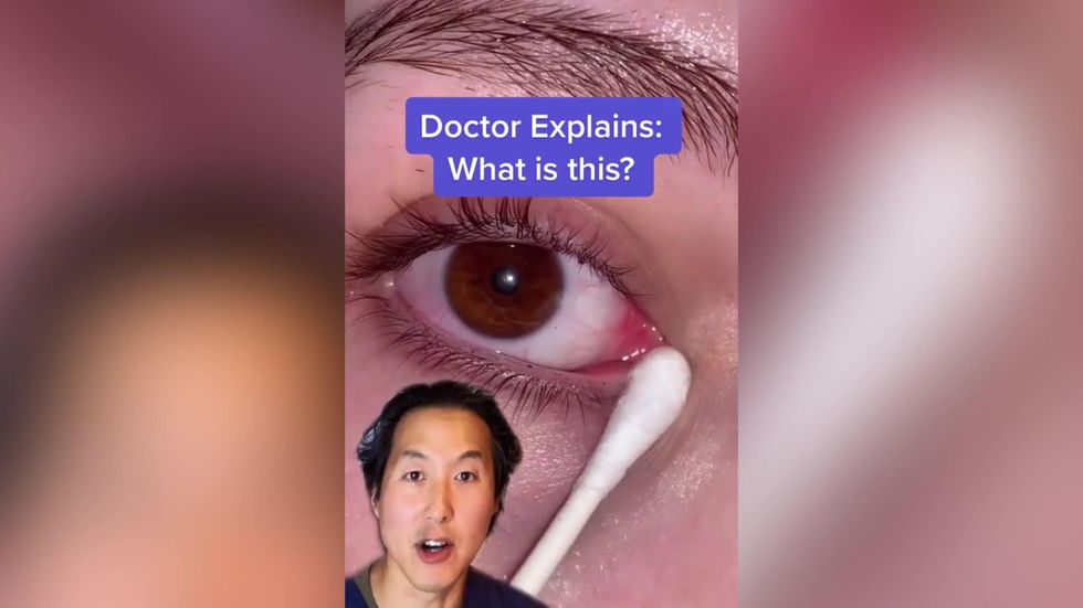 Types of Eye Mucus, Discharge, and Boogers